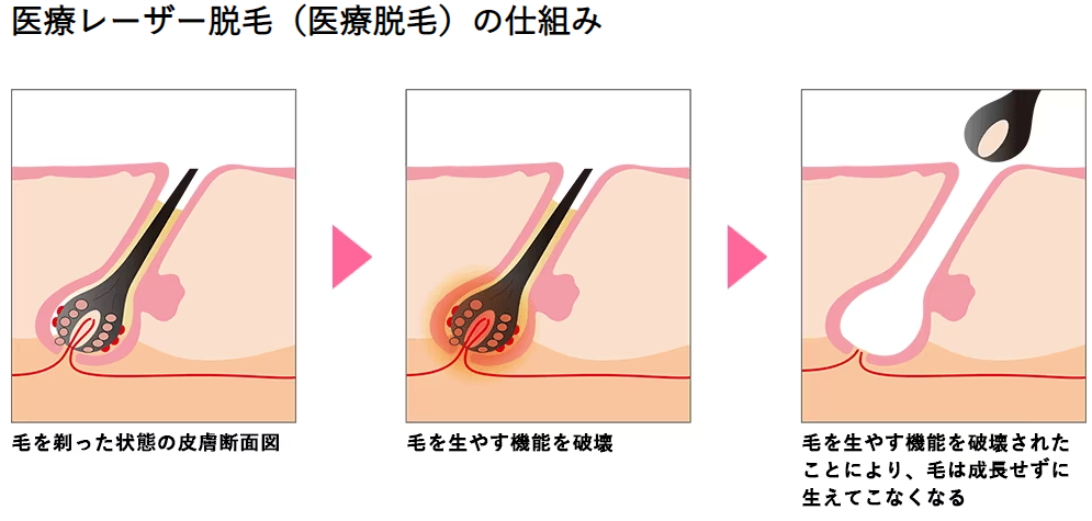 メンズTBCのヒゲ脱毛｜料金は高い?体験の口コミは悪い?脱毛効果や痛みも解説