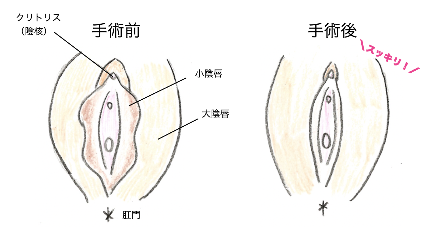 クリトリスが大きいことがコンプレックスです。目測では乳首ぐらいの大きさがあります。 | Peing -質問箱-