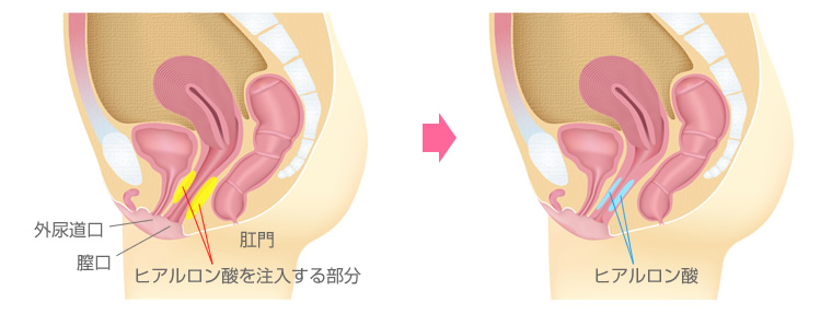 膣の上付き下付きの判別方法は？挿入のコツ - 夜の保健室