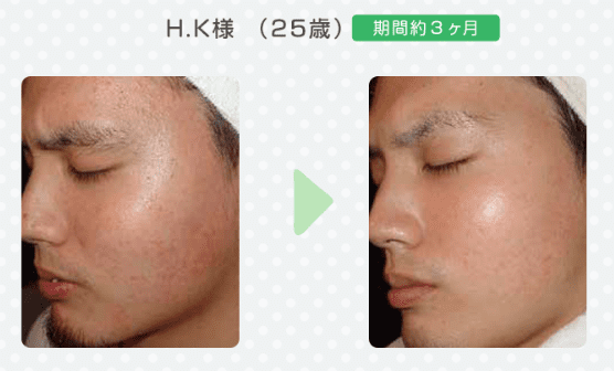 フェイシャルエステが安いおすすめのサロン6選を紹介！│レビュー for Beauty