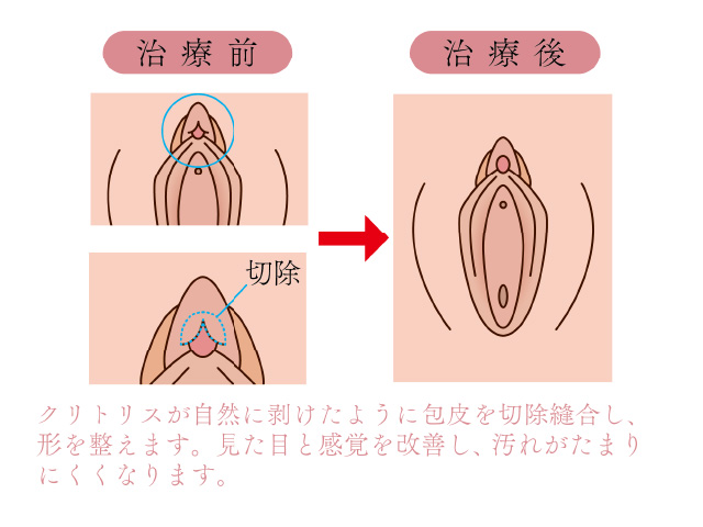 陰核（クリトリス）包茎手術｜大阪梅田【エースクリニック】HEPナビオ院