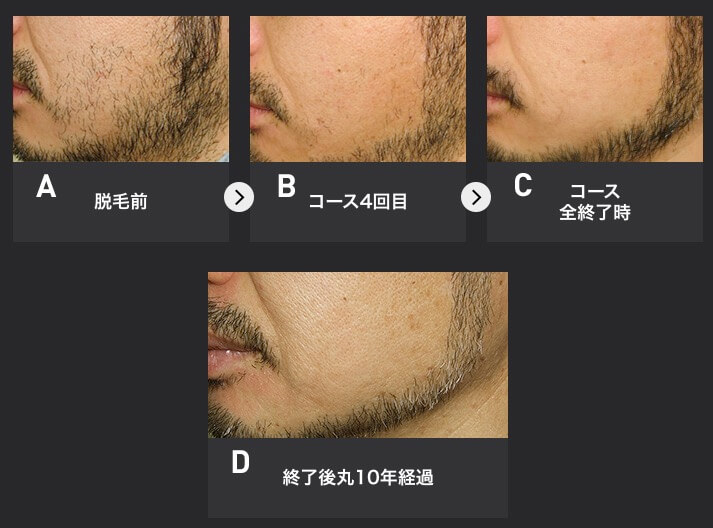 衝撃の効果】メンズTBCヒゲ脱毛で悩みは一掃！体験した痛みと勧誘 | ヒゲ脱毛ガイド