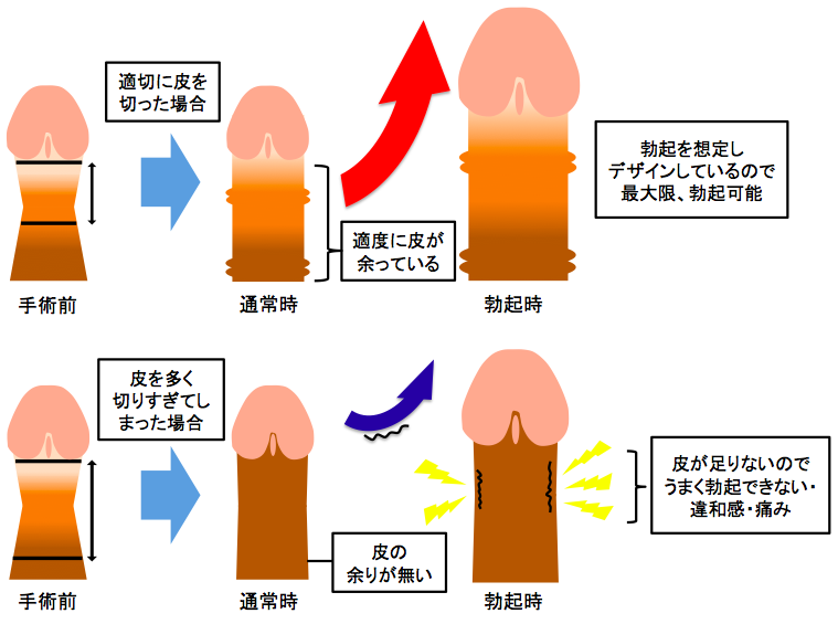 男児のママが必ずぶち当たる「おちんちんの皮むく？むかない？」問題（大泉 りか） | 現代ビジネス |