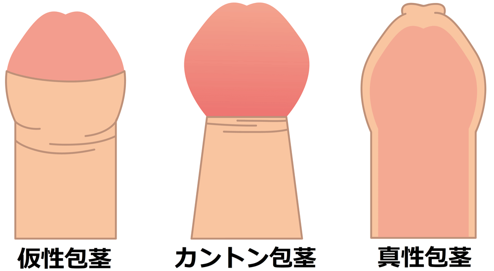 現役医師が解決】10代が抱えるペニスの悩み – メンズ形成外科