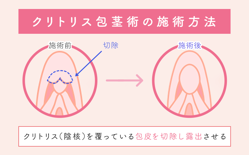 女性の包茎】クリトリス包茎とは？原因や影響を徹底解説！│SELECT CLINIC TIPS