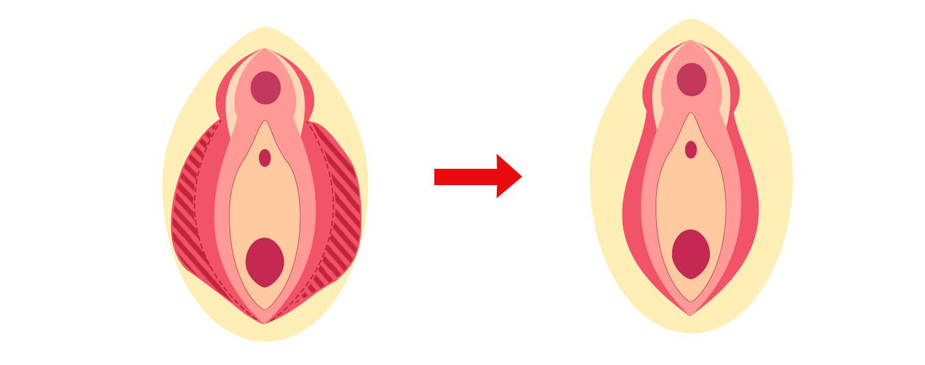 クリトリス包茎手術｜見た目・感度を改善！女性器整形「クリトリス包茎手術」の効果・経過・ダウンタイムとは｜美容整形・美容外科のTAクリニックグループ