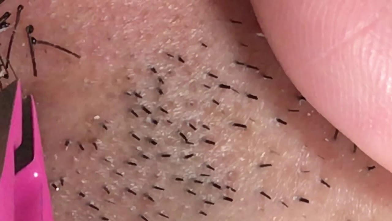 Plucking facial hair & ingrown