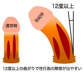 男性器に曲がりや痛み～中高年に多いペロニー病（東邦大学医療センター大森病院泌尿器科 三井要造講師）～｜医療ニュース 