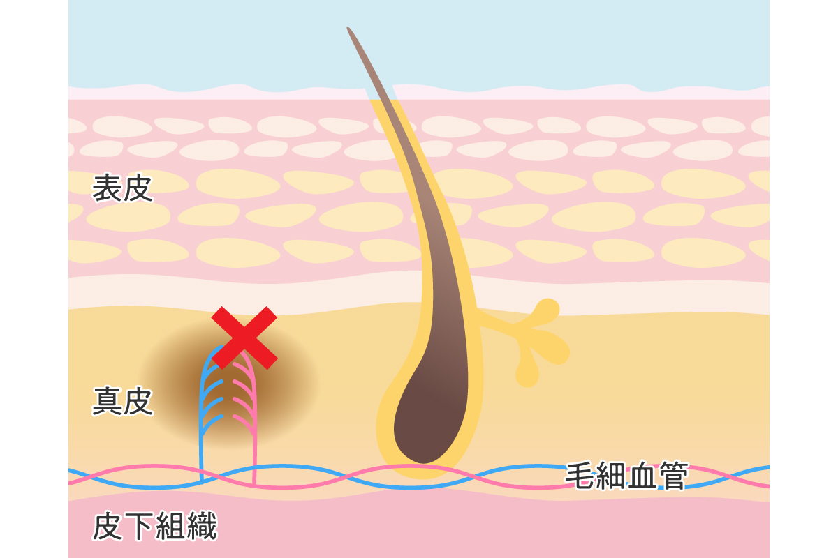 キスマークの隠し方5選！消し方や隠しきれなかった時の言い訳も紹介 - girlswalker