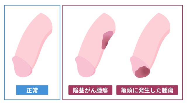 ちんこから膿が出てきたら 病気の診断方法と治療方法を解説します | 泌尿器科｜GOETHE メンズクリニック東京駅