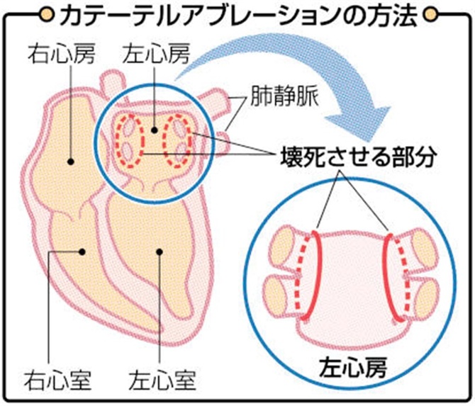 二次障害とは？ ～元々の障害が引き起こす他の障害 | 全国地域生活支援機構