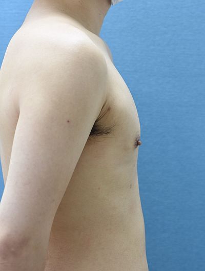 症例写真】30代男性のお腹、わき腹、背中、腰の脂肪吸引をした症例：美容外科 高須クリニック