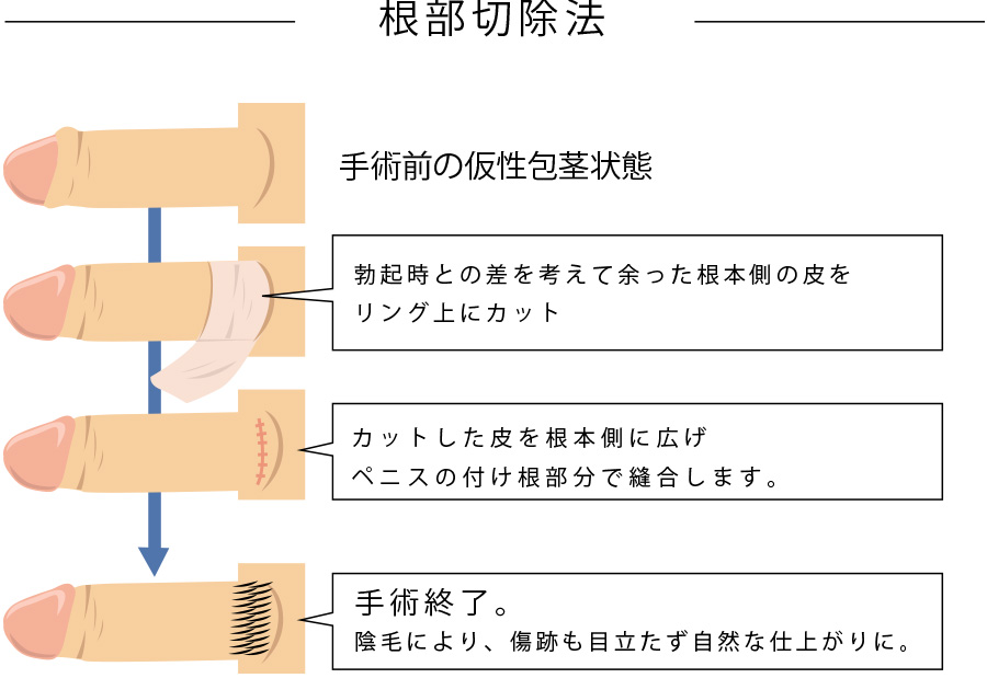 正しく包茎の皮をむく方法とは？包茎を治す方法を分かりやすく解説 - まちかど薬局情報館