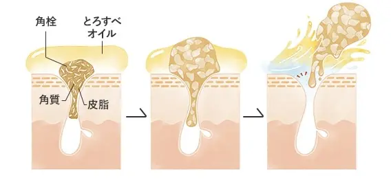 脂腺増殖症（しせんぞうしょくしょう） ｜新宿 高田馬場の皮膚科・美容皮膚科「山手皮膚科クリニック」