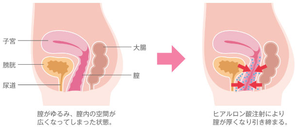 腟ナラ】セックス中や運動中に「腟からおならが出る」これって何？改善できるの？泌尿器科医に聞いた | ヨガジャーナルオンライン