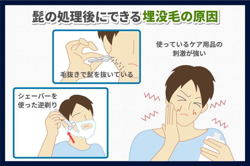 毛抜きでヒゲを抜くと生えなくなる？｜髭の自己処理方法の比較とヒゲをなくす方法 | エピステ