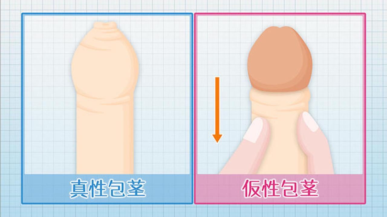 泌尿器科の専門医が解説】ペニス増大手術に関して知っておきたい８つの知識