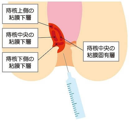 肛門外科(痔の日帰り手術の流れ)｜女性医師による肛門診察・治療、女性専用外来なら東京都豊島区巣鴨駅から徒歩1分、アイビー大腸肛門クリニック