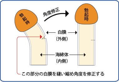 屈曲ペニス・屈曲陰茎・湾曲ペニスの詳細｜銀座みゆき通り美容外科！[東京・大阪]