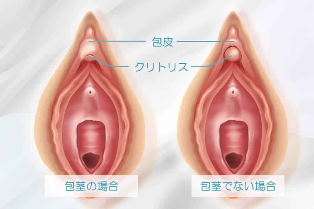 クリトリス（陰核）包茎手術 | 婦人科形成なら銀座駅徒歩0分のなおえビューティークリニック