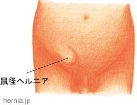 粉瘤の日帰り手術について｜京都烏丸駅前皮フ科スキンクリニック・クリニーク京都烏丸