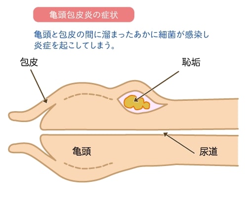 チンカス掃除してる？】ちんこの正しい洗い方について解説！ | Men's Chinchi