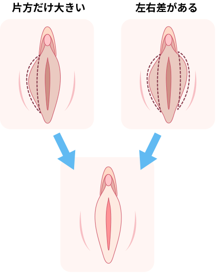 FTMの男性ホルモンの効果と発現時期