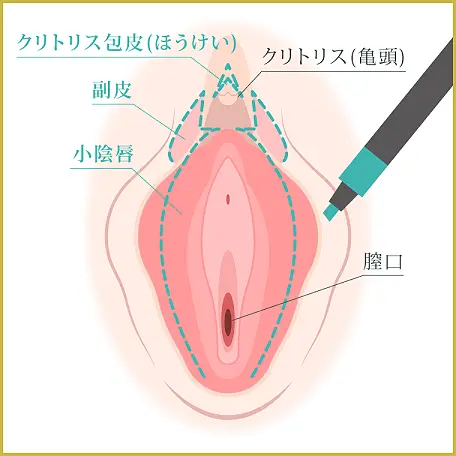 クリトリス（陰核）包茎手術 | 婦人科形成なら銀座駅徒歩0分のなおえビューティークリニック