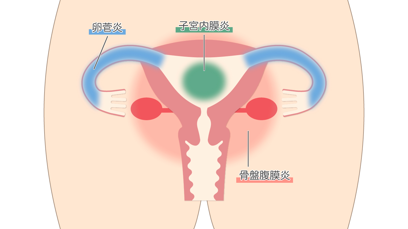 イカ臭い原因！？これが謎の病気、細菌性腟症だ！！ | 医療法人社団 予防会